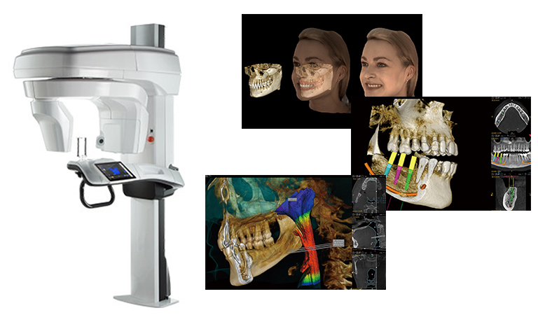 ヨシダ トロフィーパン スープリーム3D歯科用CT