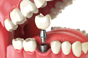 インプラント治療中の「仮歯」って？仮歯の重要性と役割について