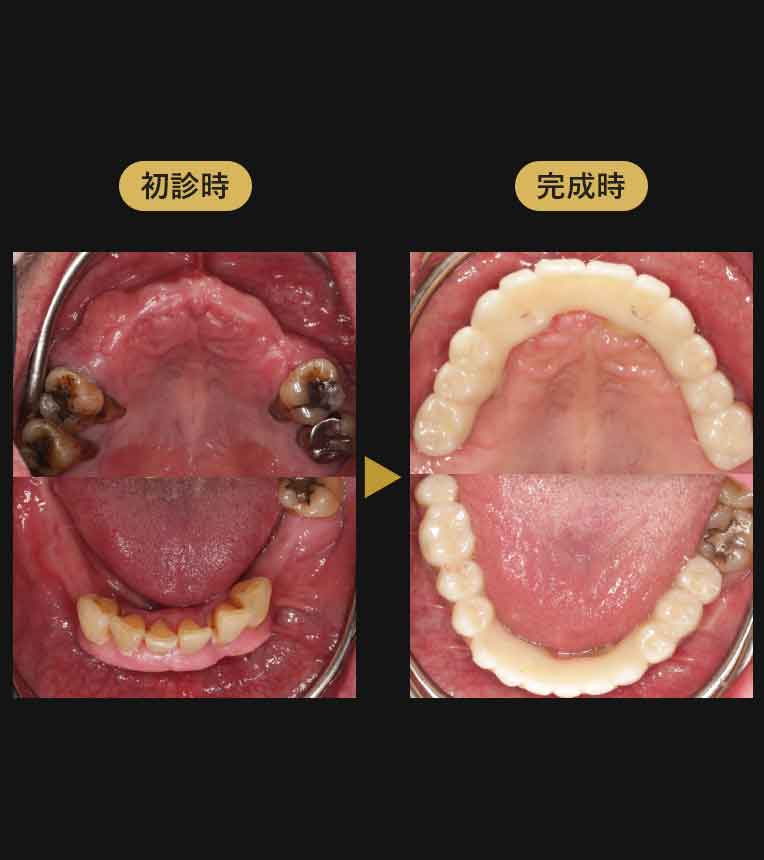 ジルコニアブリッジ症例