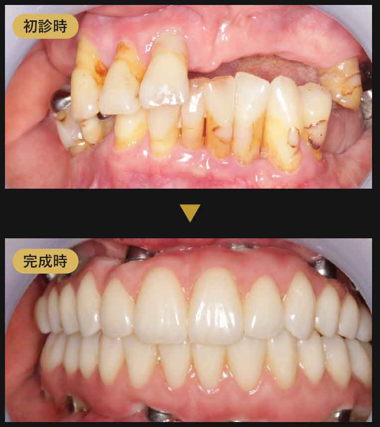 ジルコニアブリッジ症例