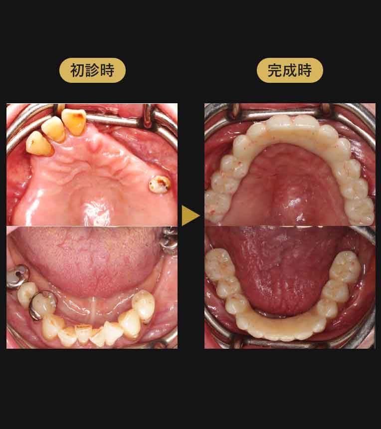 ジルコニアブリッジ症例