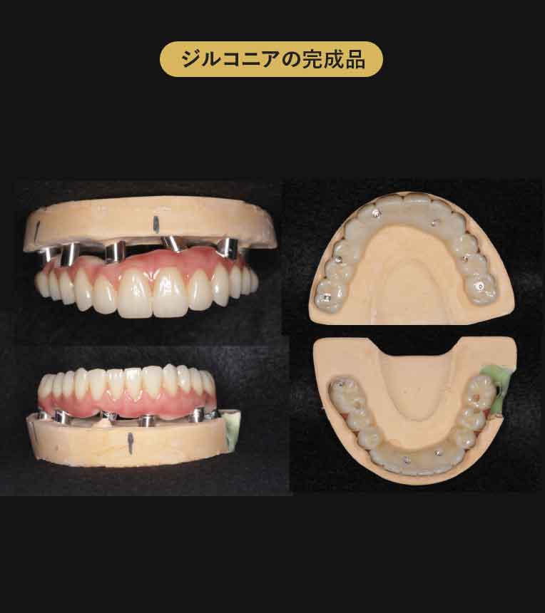 ジルコニアブリッジ症例