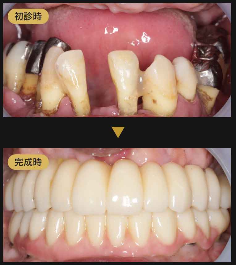 ジルコニアブリッジ症例