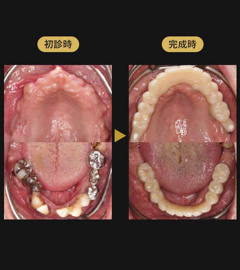 ジルコニアブリッジ症例