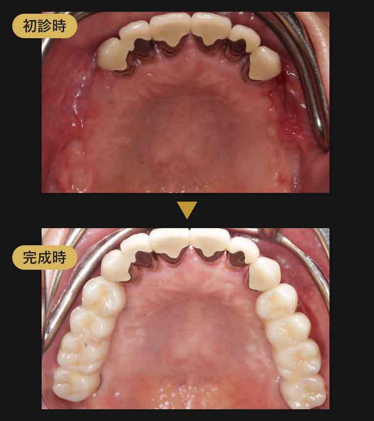 ジルコニアブリッジ症例
