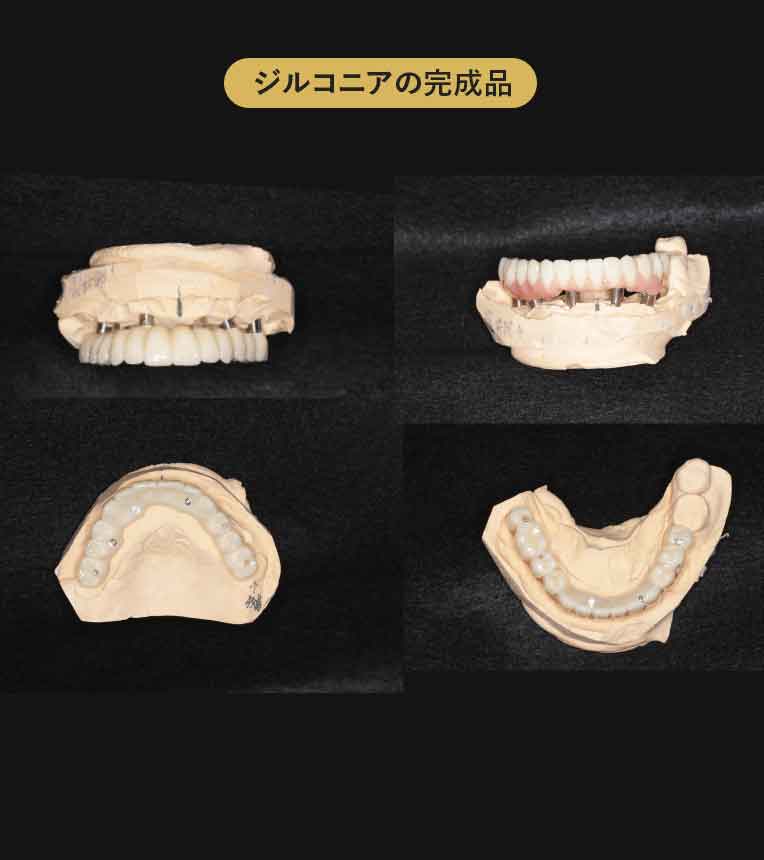 ジルコニアブリッジ症例