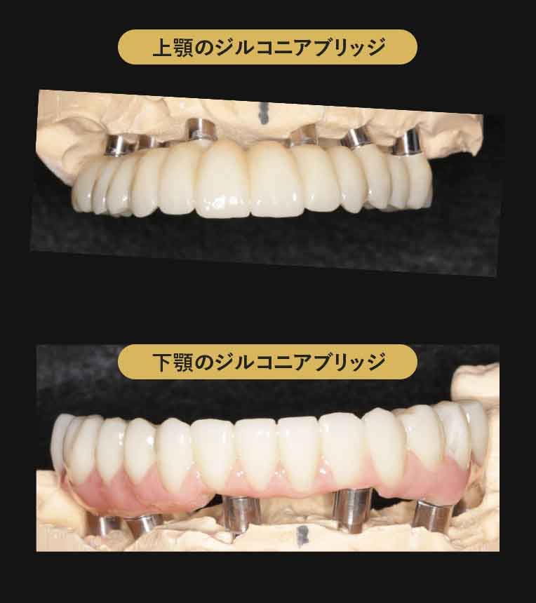 ジルコニアブリッジ症例