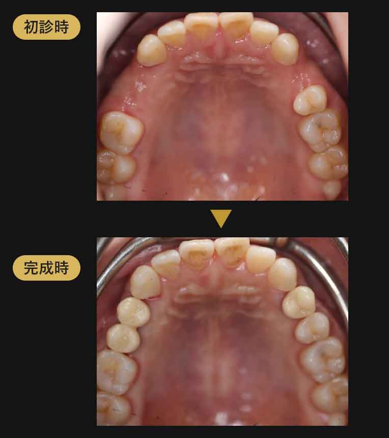 ジルコニアブリッジ症例