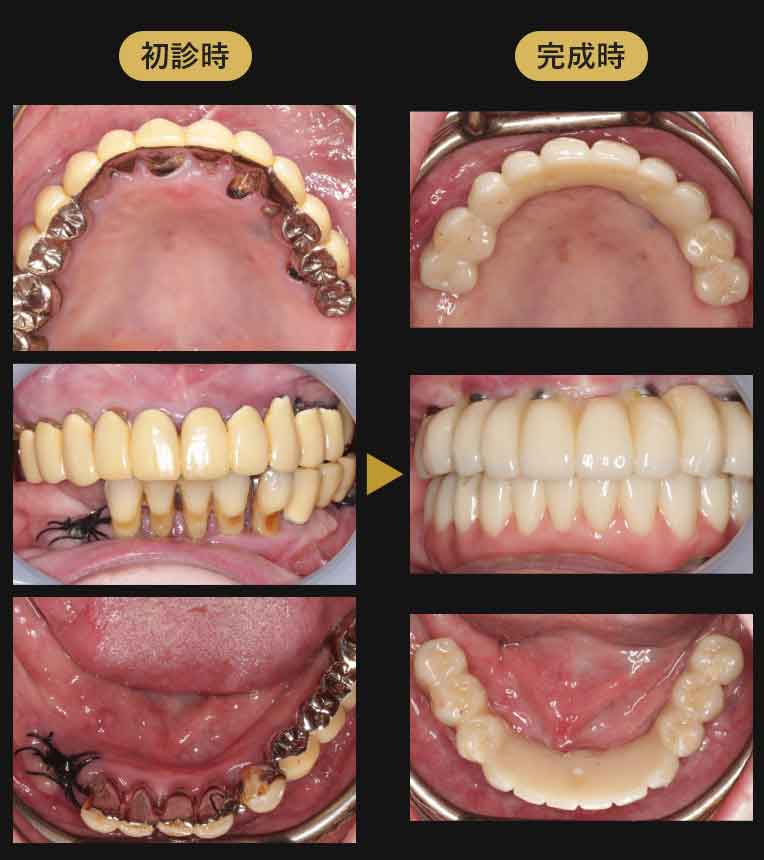 ジルコニアブリッジ症例