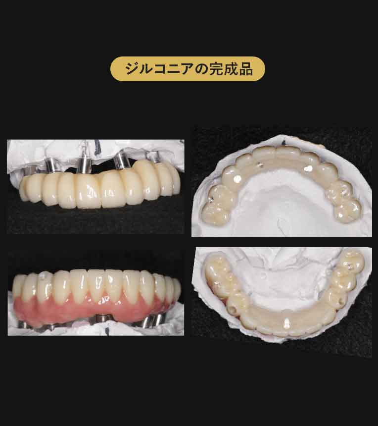 ジルコニアブリッジ症例