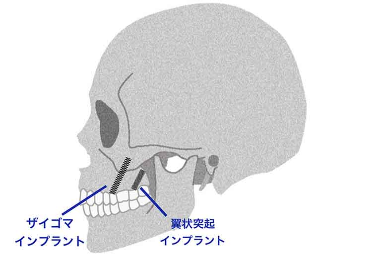 プテリゴイドインプラントとザイゴマインプラントの比較