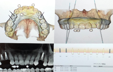 インプラント手術ナビゲーションシステムX-ガイド | 五十嵐歯科医院