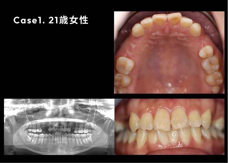 生まれつき上あごの3本の歯が欠損しており、骨の幅が少ないケース。