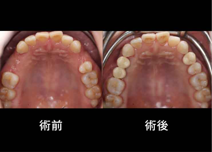 生まれつき上あごの3本の歯が欠損しており、骨の幅が少ないケース。