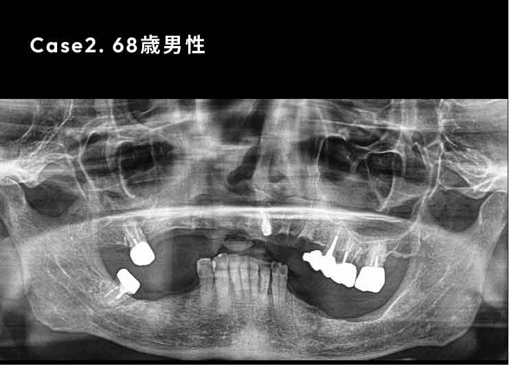 下歯槽神経近くにインプラントを埋入したケース