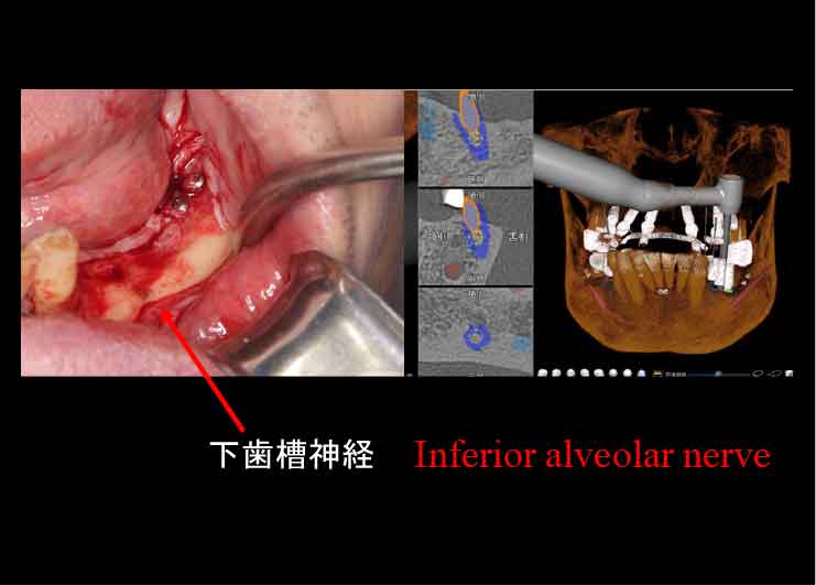 下歯槽神経近くにインプラントを埋入したケース