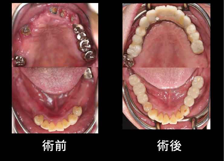 下歯槽神経近くにインプラントを埋入したケース