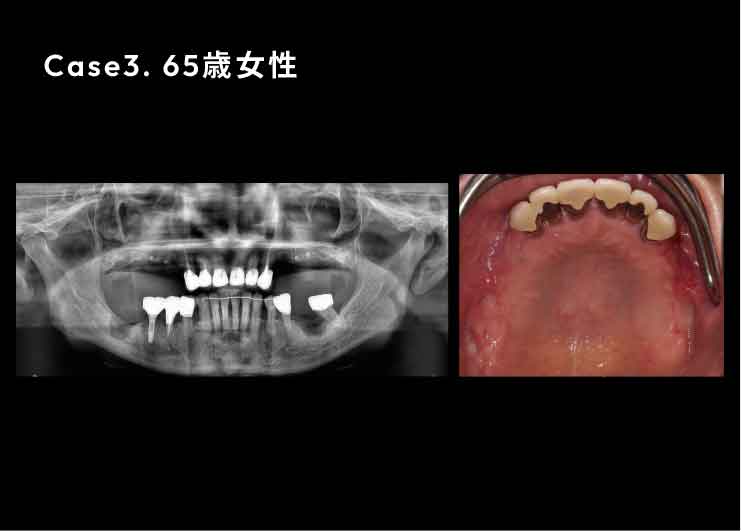 Case3. 65歳女性