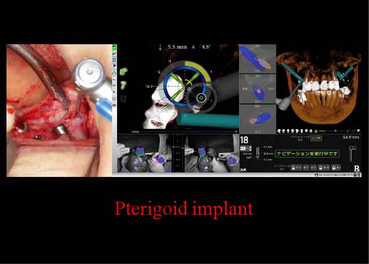 プテリゴイド(蝶形骨)インプラント
