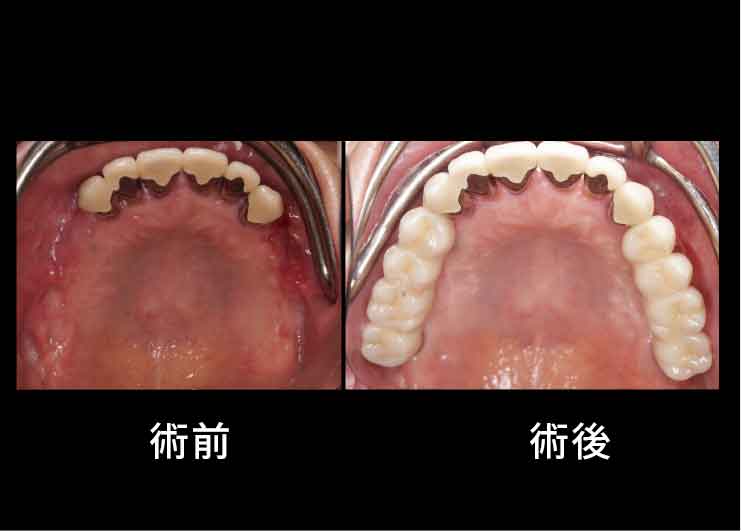 脂肪組織をインプラント表面に挿入