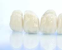 ブリッジと入れ歯 どちらの治療が正解 失った歯に対する治療法 五十嵐歯科医院