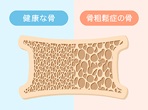 骨粗鬆症でもオールオン４はできる？